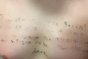 Chest tattoo partially faded after first laser tattoo removal session