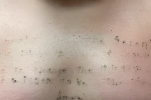 Chest tattoo significantly faded after fourth laser removal session