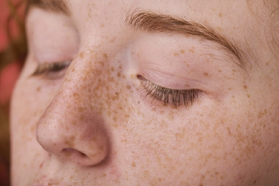 Pigment Correction at Lotus Leser Aesthetics