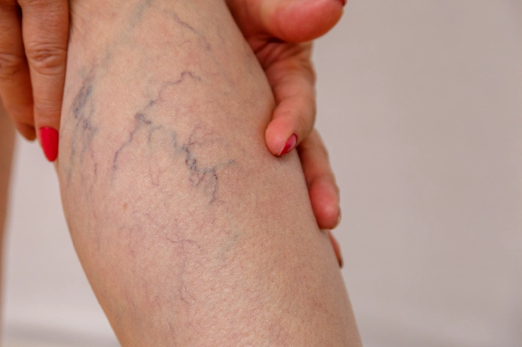 Close-up of leg showing visible spider veins before vascular lesion laser treatment at Lotus Laser Aesthetics