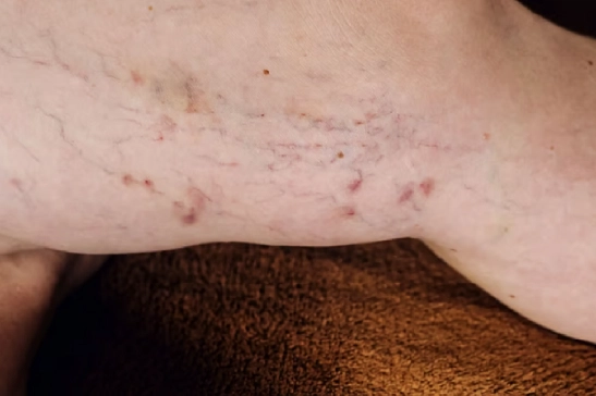 Before and after results of vascular lesion laser treatment showing improved skin appearance and reduced spider veins.
