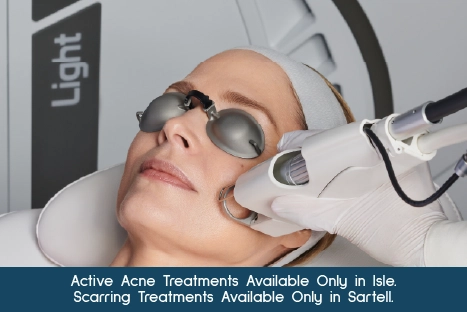Active Acne & Acne Scarring treatment at Lotus Laser Aesthetics