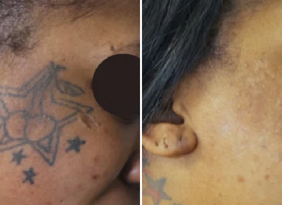 Before & After Submissions Photos at LLA.