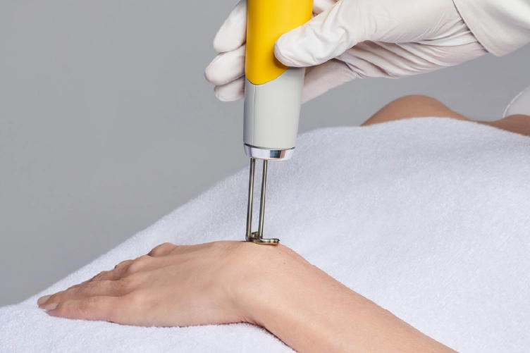 Laser treatment for hair removal in progress, offering smooth, hair-free skin with precision and comfort.