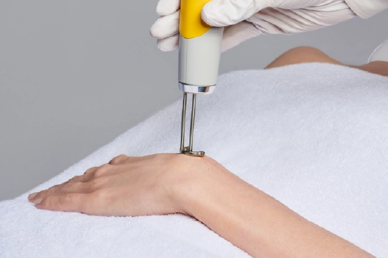 Close-up of a tattoo removal treatment on a client's hand at LLA