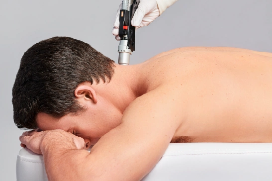 Laser hair removal treatment on a man's back, ensuring smooth, hair-free skin with expert care.
