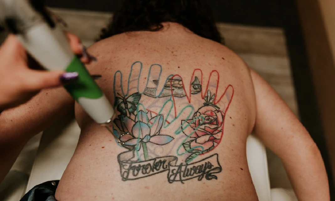 Laser Tattoo Removal performing at LLA