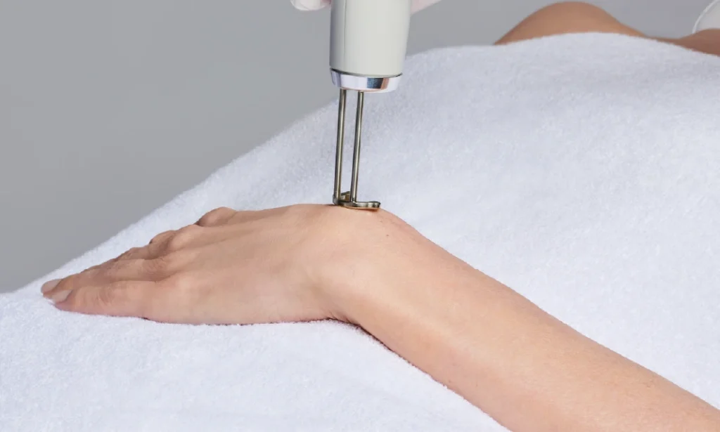 Laser tattoo removal