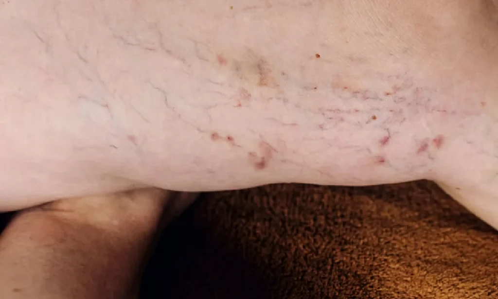 Spider vein laser removal treatment for at Lotus Laser Aesthetics