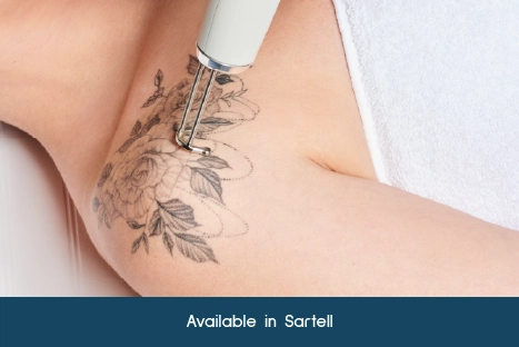 Tattoo Removal at Lotus Laser Aesthetics