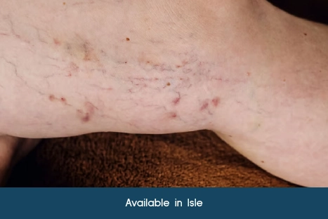 Vascular Lesions at Lotus Laser Aesthetics