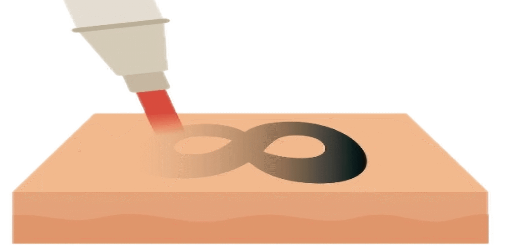 Tattoo Removal-Sartell, MN